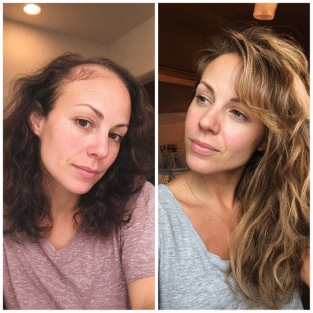 Embracing Change: Healing from Postpartum Hair Loss